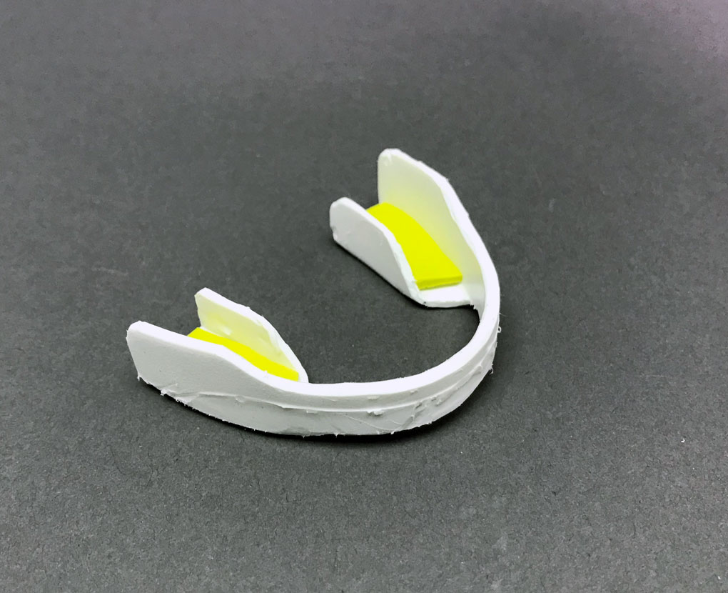 Trimmed Mouthguard with Inserts